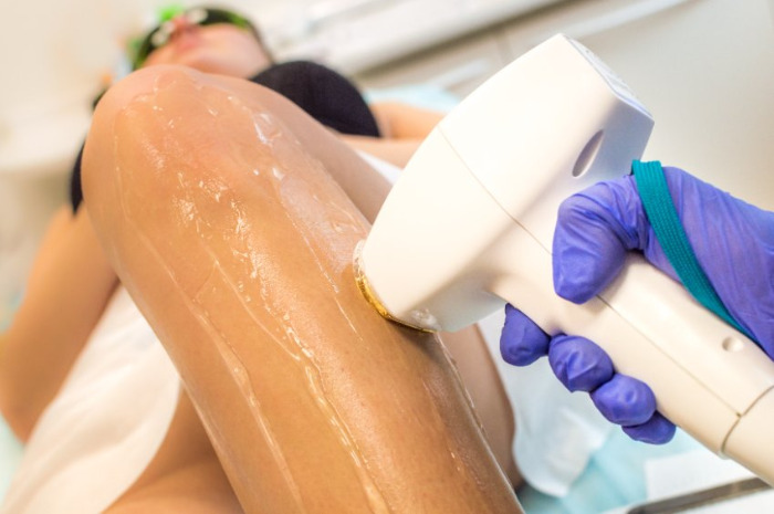 Pourquoi l'épilation au laser est-elle toujours populaire en 2026 ?